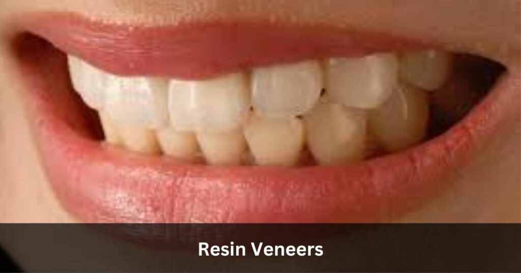 Resin Veneers