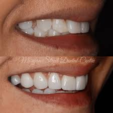 How Are Resin Veneers Applied 