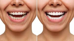 Advantages Of Composite Resin Veneers In Tampa 